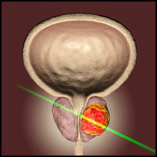 Illustration highlighting an inflamed area of the prostate.